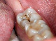 Imagen de una parte de la boca, con lengua dientes y mejilla. En el último molar se ve una caries de surcos y fisuras.  