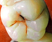 CPCI01_SOL_R01_caries_surcos.jpg