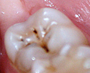 CPCI01_SOL_R02_caries_surcos_y_fisuras.jpg