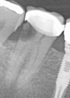 Imagen radiográfica donde se ve un molar con una extensa caries radicular.