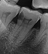 Imagen radiográfica donde se ve un molar con una caries con afectación pulpar.