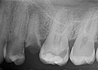 Imagen radiográfica donde se ven varias piezas dentales con caries, una de ellas prácticamente destruida.
