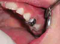 Imagen de un molar temporal superior al que se le ha colocado una corona reformada de metal.