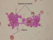 Imagen de una extensión de sangre vista al microscopio donde se pueden observar algunos hematíes dispersos con forma de disco y coloreados de naranja y agregados de plaqueta constituidos por grupos de pequeños discos de color morado.