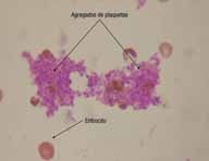 Imagen de una extensión de sangre vista al microscopio donde se pueden observar algunos hematíes dispersos con forma de disco y coloreados de naranja y agregados de plaqueta constituidos por grupos de pequeños discos de color morado.