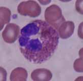 Se observan varios hematíes y un eosinófilo con núcleo lobulado de color azul y granulaciones eosinófilas.