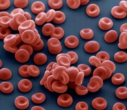 Se ven formas circulares coloreadas de rojo y   forma tridimensional característica de los hematíes con la zona central más hundida, dispuestos aleatoriamente sobre una superficie coloreada de azul.