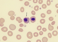 Frotis sanguíneo donde se pueden observar un grupo de hematíes normales y en el centro dos hematíes nucleados.