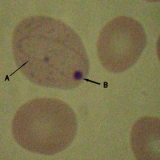 Hematíes en los que en uno de ellos se aprecia un filamento circular y punto oscuro.