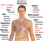 Se ve a un hombre de cabeza hasta la cintura con un rótulo superior “Anemia”, alrededor de la figura se reparten los nombres de todos los signos y síntomas de la anemia relacionándolos con flechas con la zona corporal donde se manifiestan. Idioma inglés. 