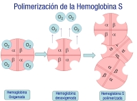 Esquema en el que se observa la Hemoglobina S saturada de cuatro moléculas de oxigeno, la hemoglobina desoxigenada y la Hb S polimerizada.    