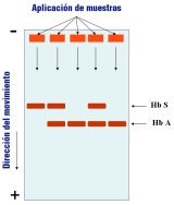 Esquema de una electroforesis de hemoglobina con cinco muestras donde se observan la aparición de bandas correspondientes a hemoglobina A y hemoglobina S.