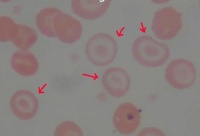 Imagen número 5 de la actividad 5. Extensión de hematíes alterados morfológicamente.    