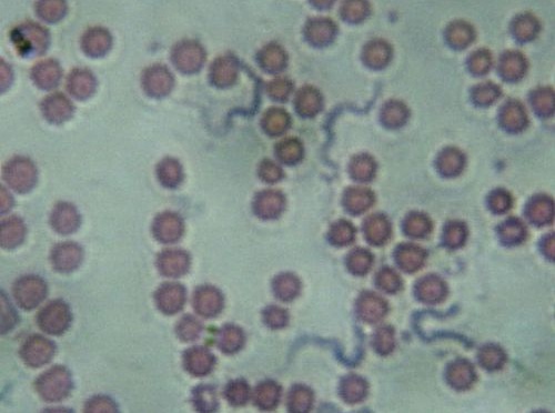 Imagen número 7 de la actividad 5. Extensión de hematíes alterados morfológicamente.  