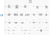 En la imagen se puede observar un cariotipo realizado en una célula tumoral. Se pueden observar varios cromosomas de mas en algunos pares cromosómicos y un cromosoma marcador.