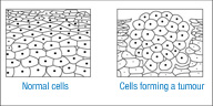 En la imagen se puede apreciar un dibujo que simula un tejido normal y a su derecha otro dibujo del mismo tejido en el que se ha producido la proliferación de algunas de sus células dando lugar a un tumor.